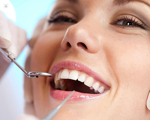 Amalgam Removal in Tampa