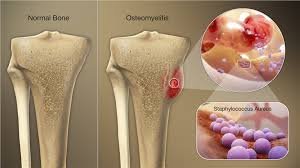 Best Osteomyelitis doctor, treatment