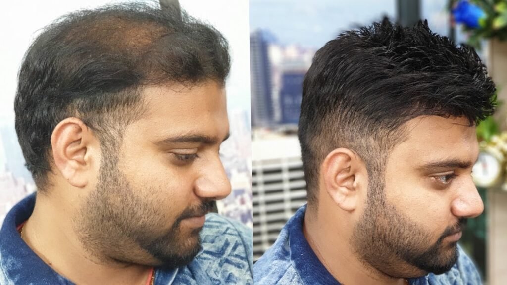 Best Hair Transplant in Pakistan