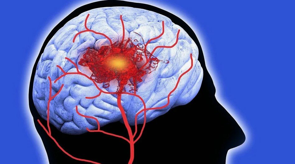 Best Stroke Treatment Honolulu 2025 – Fast Recovery Guide