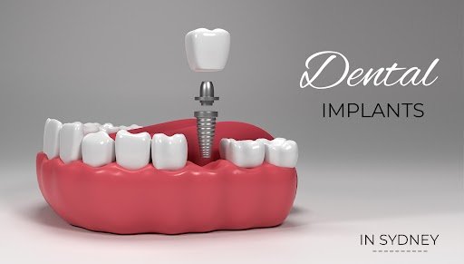 dental implants in sydney